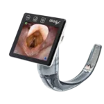 Video laryngoscope showing vocal cords on screen during intubation