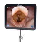 Close-up of the Airtraq Max View monitor displaying glottis view during laryngoscopy.